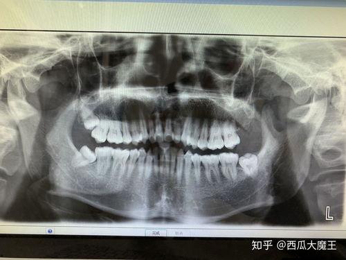 拔蛀牙视频全过程图片,一图看懂拔蛀牙全过程